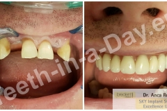 Full mouth rehabilitation complete upper jaws