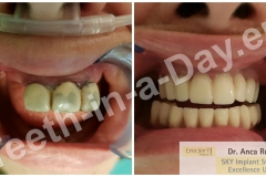 Full mouth rehabilitation complete upper jaws