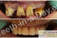 full-mouth-reconstruction-rehabilitation-restoration-upper-jaws (3)