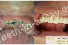 full-mouth-reconstruction-rehabilitation-restoration-upper-jaws (4)