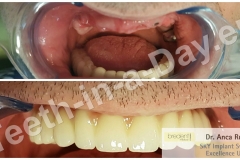 full-mouth-reconstruction-rehabilitation-restoration-upper-jaws (5)