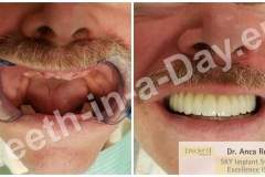 full-mouth-reconstruction-rehabilitation-restoration-upper-jaws (6)