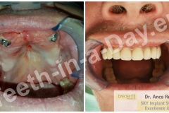 full-mouth-reconstruction-rehabilitation-restoration-upper-jaws (7)