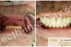 New teeth in a day complete upper jaws rehabilitation