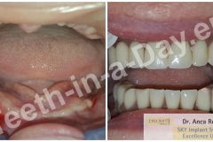 Full mouth reconstruction complete upper and lower jaws